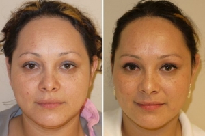 Botox en Sevilla - Antes y Después :: Central Clinic :: Medicina Estética Sevilla