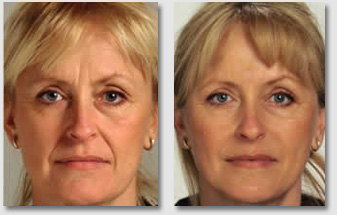 Relleno Facial Sevilla - Antes y Después - Central Clinic