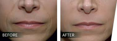 Relleno Facial Sevilla - Antes y Después - Central Clinic